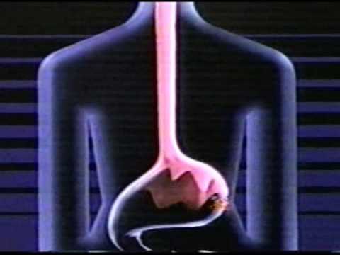 An pepto bismol commercial.